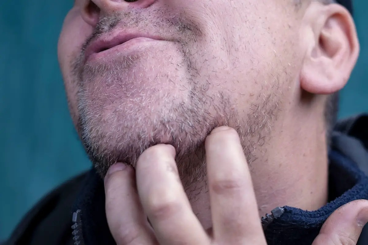 how to deal with beard dandruff