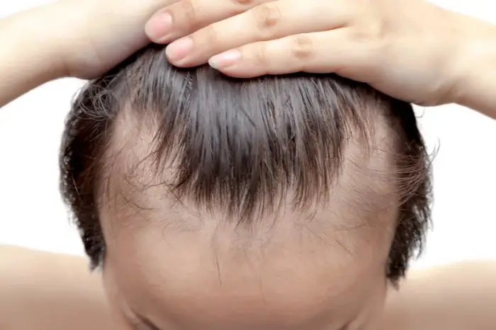 What Causes Balding At Young Age
