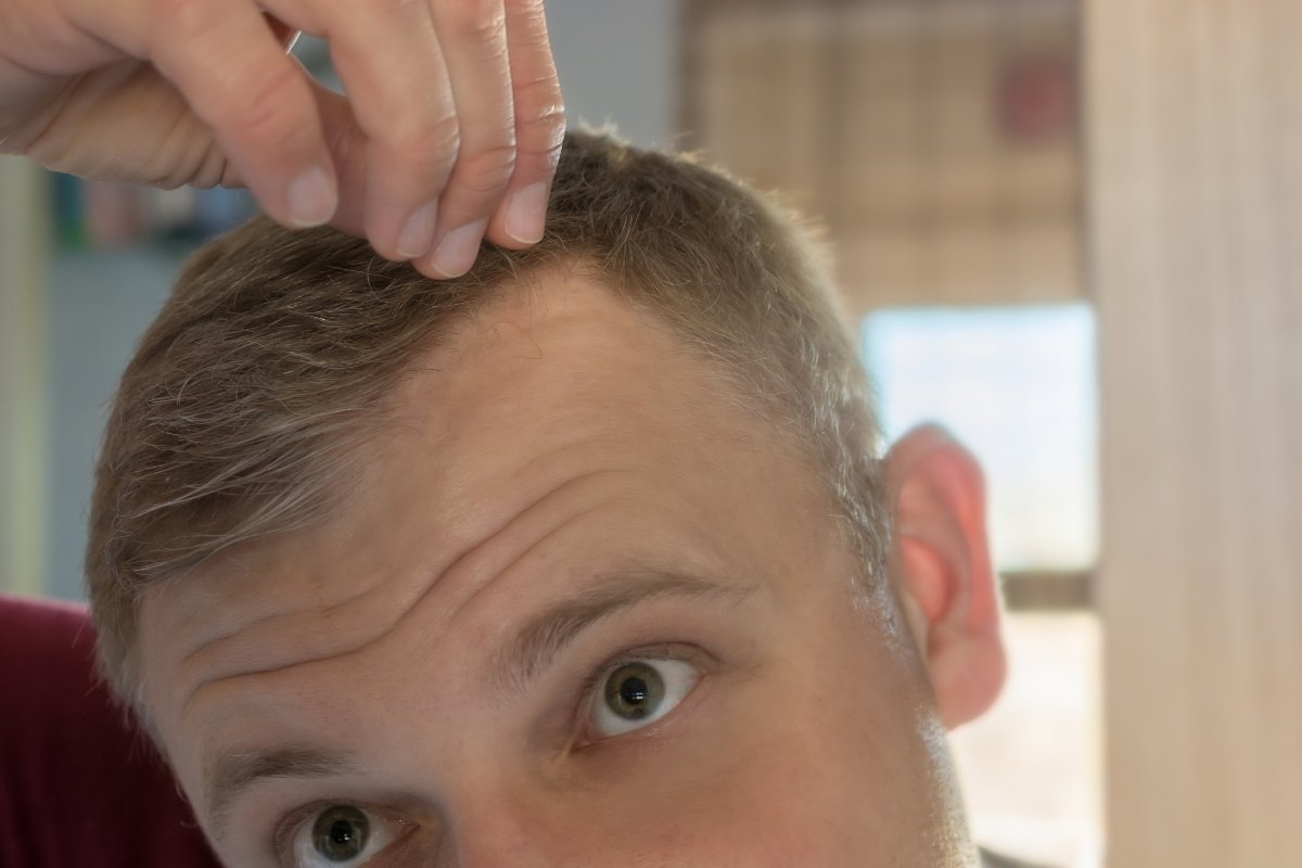 What causes receding hairline early 20s